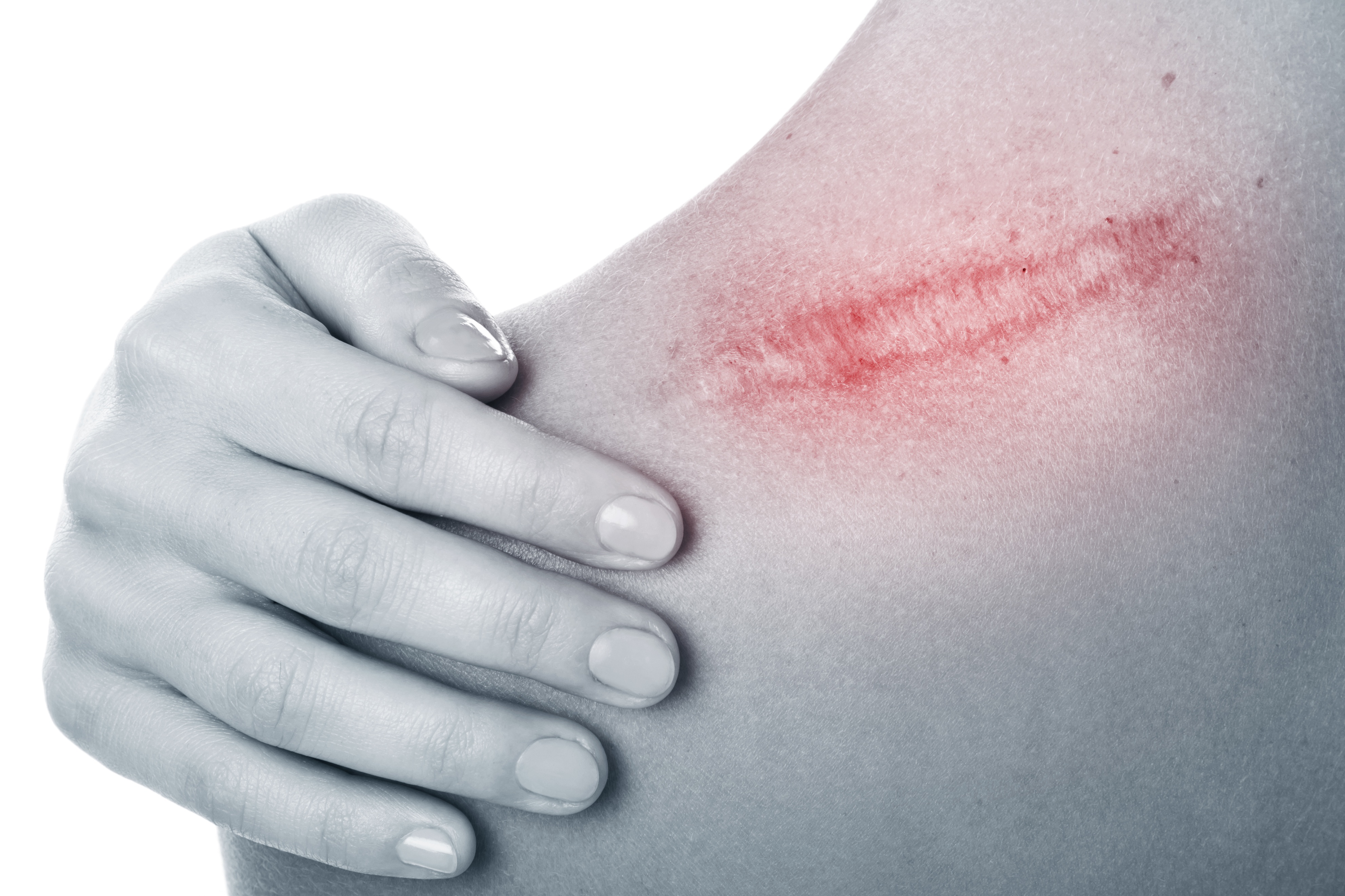 疤痕体质怎么办需要注意什么,伤口疤痕增大不一定是疤痕体质