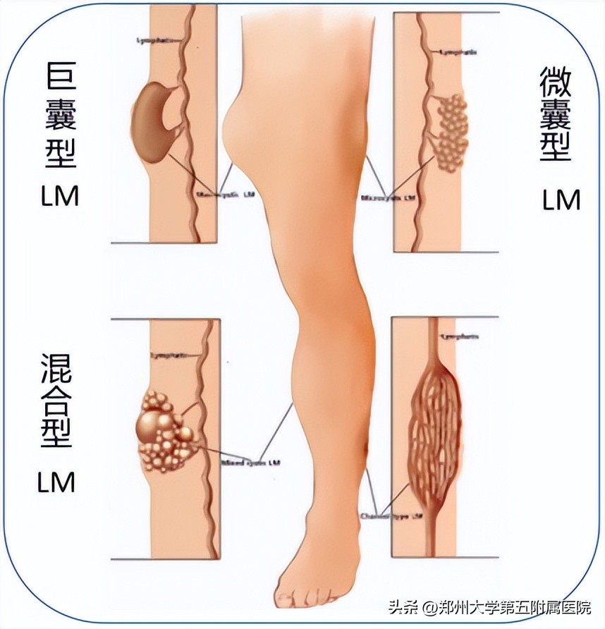 水囊瘤宝宝的存活几率,水瘤一般都是长在哪里