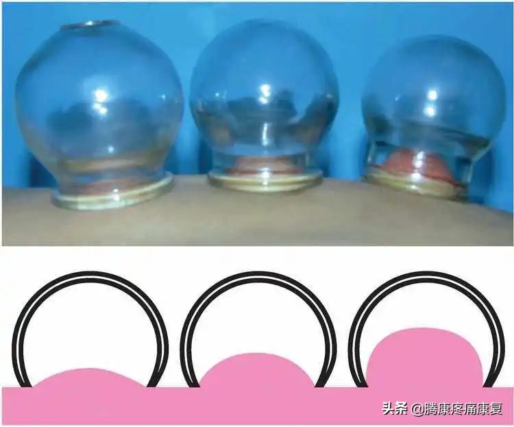 瘢痕灸疗法,瘢痕疙瘩拔罐怎么样