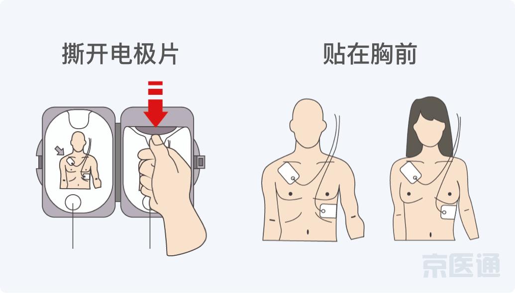 一高校学生跑操心脏骤停,北京一高校心脏骤停