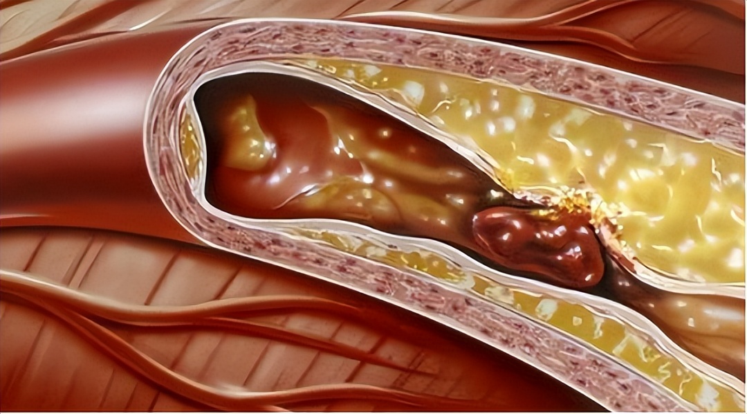 肾结石能吃蛋一类的食物吗,肾结石治疗期间可以吃鸡蛋吗