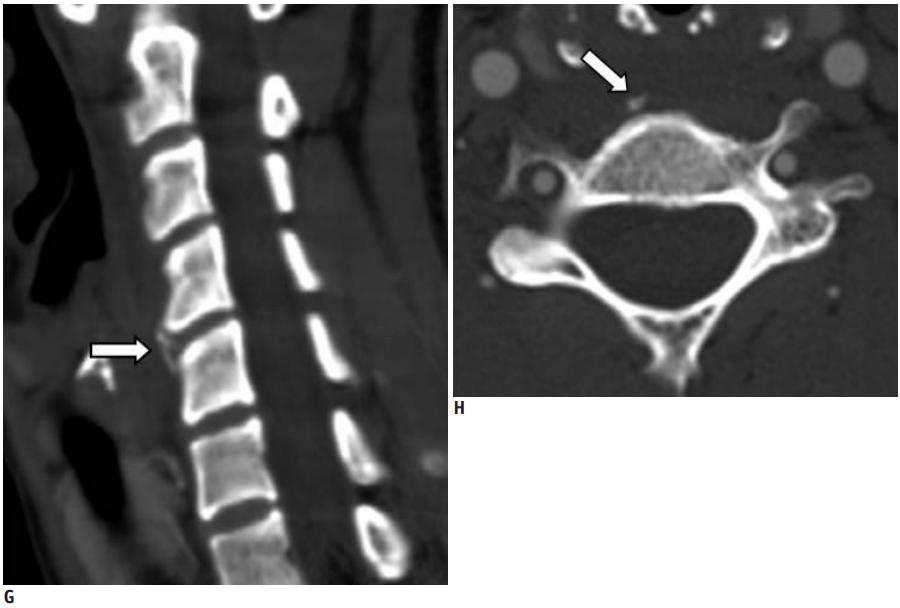 颈长肌腱炎影像表现,三头肌钙化性肌腱炎治疗