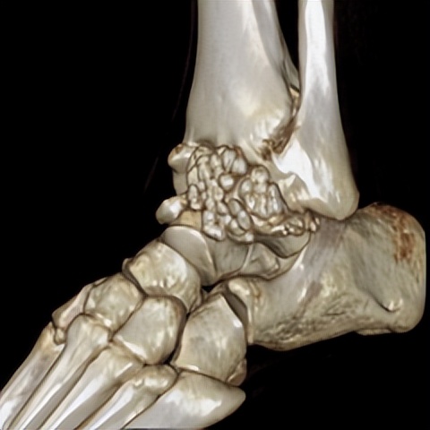 脚踝扭伤的处理方法和康复,脚踝扭伤立即进行的正确处理方法