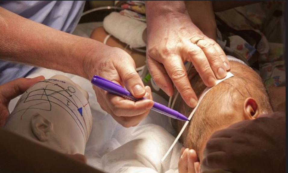 巴西连体双胞胎成功分离后续,巴西头部连体婴儿分离后续