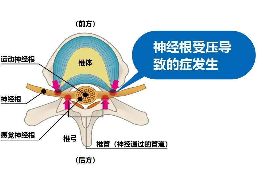 腰椎管狭窄腰腿痛间歇性跛行,腰椎管狭窄压迫神经腿麻木怎么治