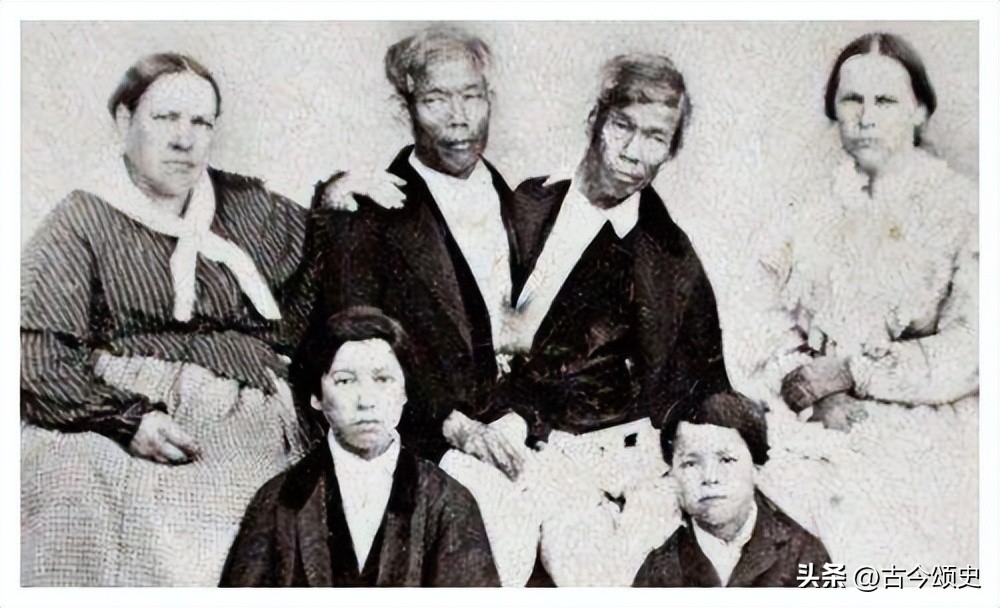 连体人结婚生子,连体人如何生子