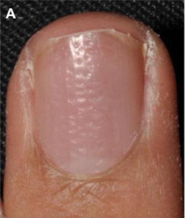 指甲有竖纹有月牙怎么回事,指甲月牙不是很白怎么回事