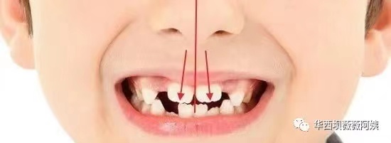 儿童早期牙齿矫正华西,华西口腔小孩矫正牙齿是什么科
