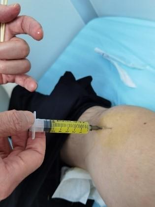 “一针扎进去，关节液自动流出来了”，过完年，这种病又开始发作了