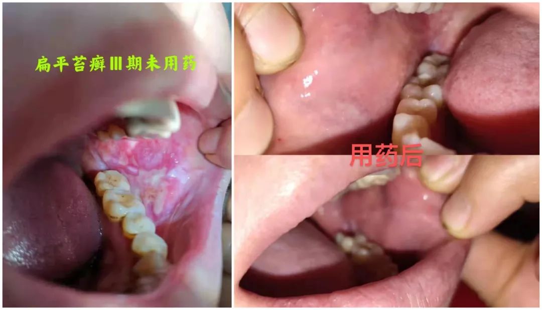 口腔溃疡反复发作，是缺维生素了？你可能一直都错了！改善口腔疾病，这个方法效果好