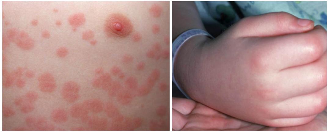 儿童生疹子哪里红点多,怎么区分孩子起的各种疹子