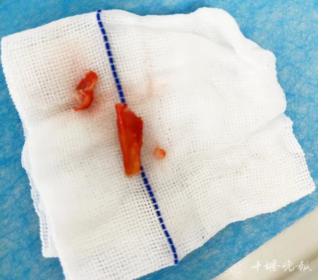 吃了小龙虾急救,吃了麻辣小龙虾呼吸困难