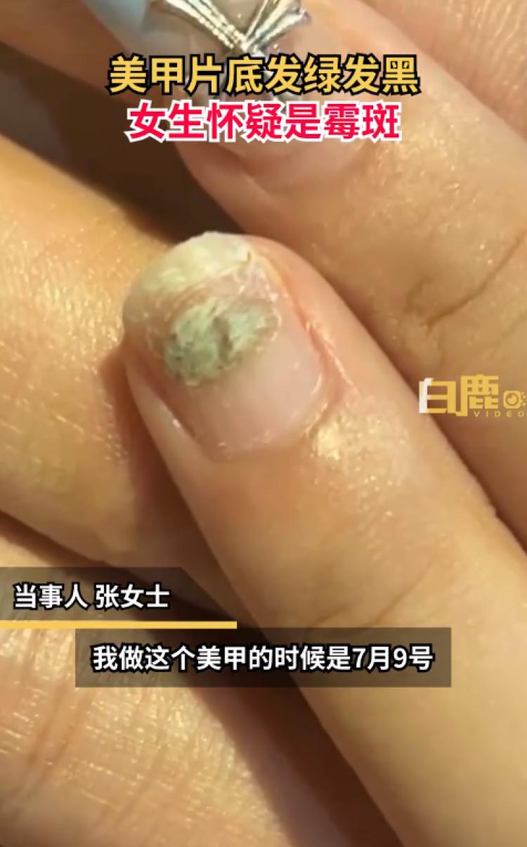 吓人！女生美甲片底发绿发黑疑长霉斑，医生：穿戴甲贴合度不高，会导致铜绿假单胞菌感染