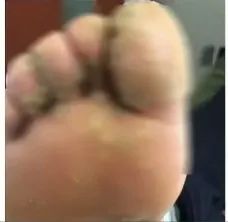 10岁男孩游泳班感染hpv,浙江一小男孩上游泳课感染hpv