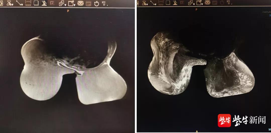 14岁女孩乳房“疯狂”发育，大如篮球