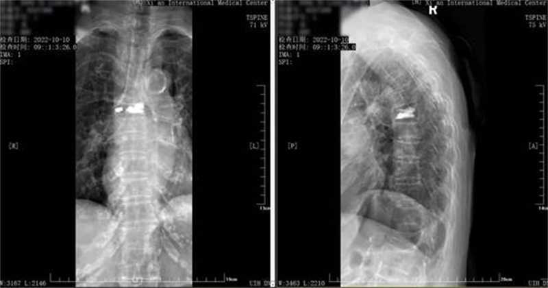 百岁老人骨折竟奇迹般恢复,老人骨折卧床100天还能走路吗