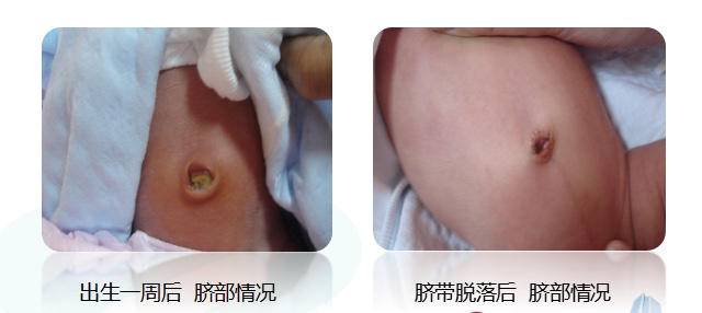 宝宝脐部炎症应该怎样护理,怎样护理宝宝的脐部
