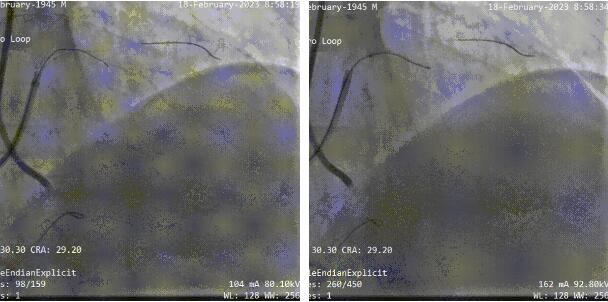 3DF打印助力温州医科大温州医科大学附属第一医院周浩团队完成一例复杂高危的冠脉CTO手术