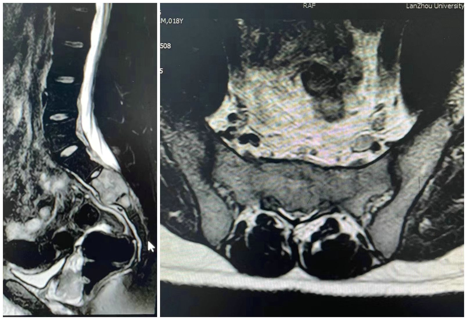 兰大二院腰椎间盘突出微创手术,兰大二院微创介入治疗
