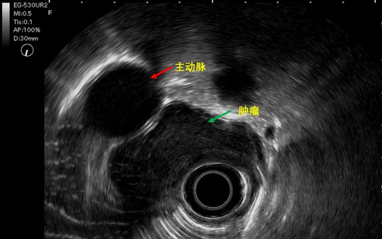 食管长满菜花状肿瘤,食管长个0.5的瘤子需要治疗吗