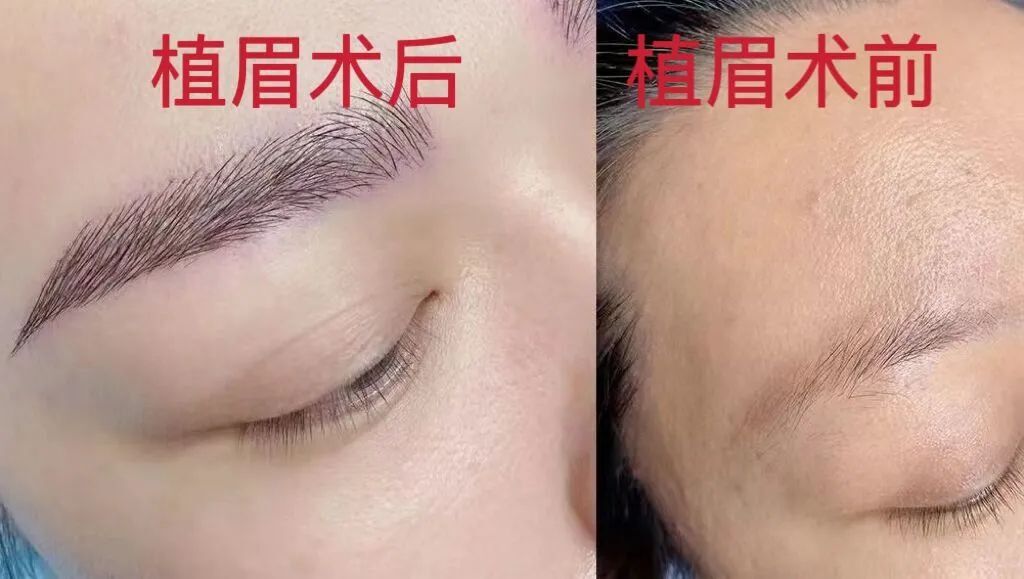 毛囊种植眉毛手术案例,微创移植眉毛手术