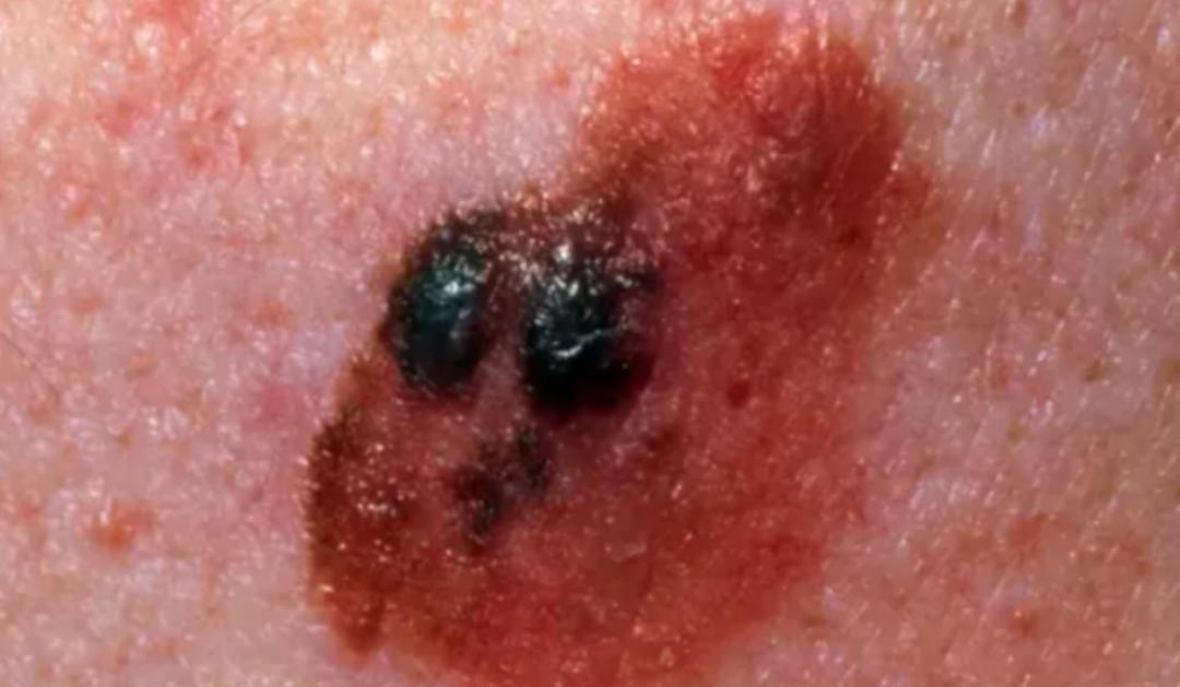 痣科普视频,科普有痣者的困扰正确认识色素痣