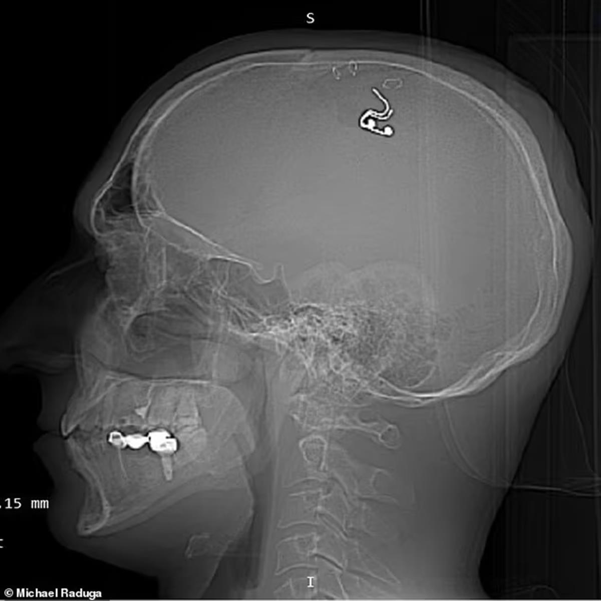 男子脑中被植入智能芯片,俄男子为控制梦境在大脑植入芯片