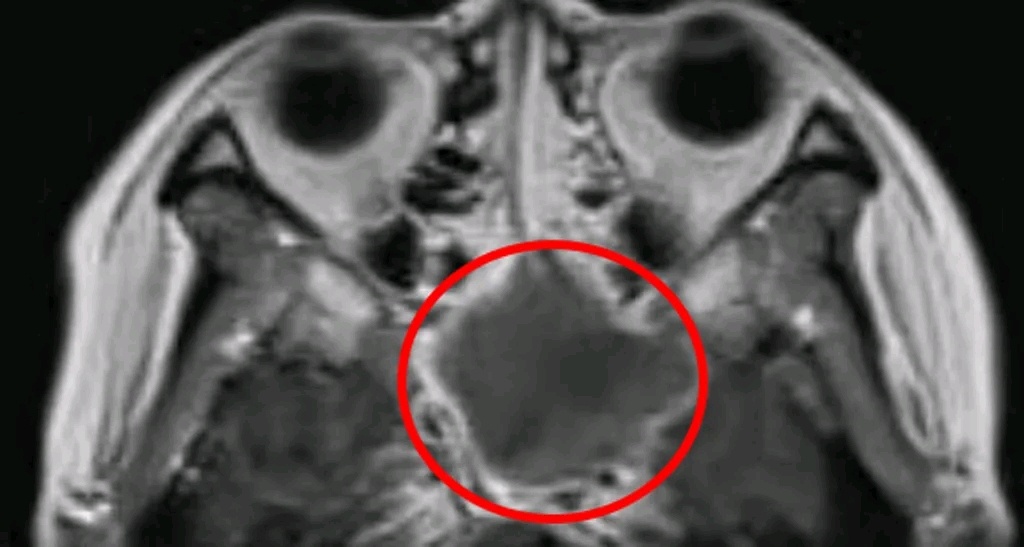 因为鼻窦炎引起头疼吃什么药,头痛引起鼻腔不适